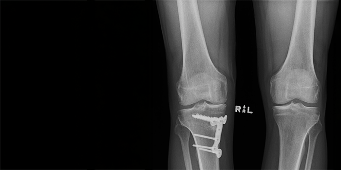 An Xray of a high tibial osteotomy implant